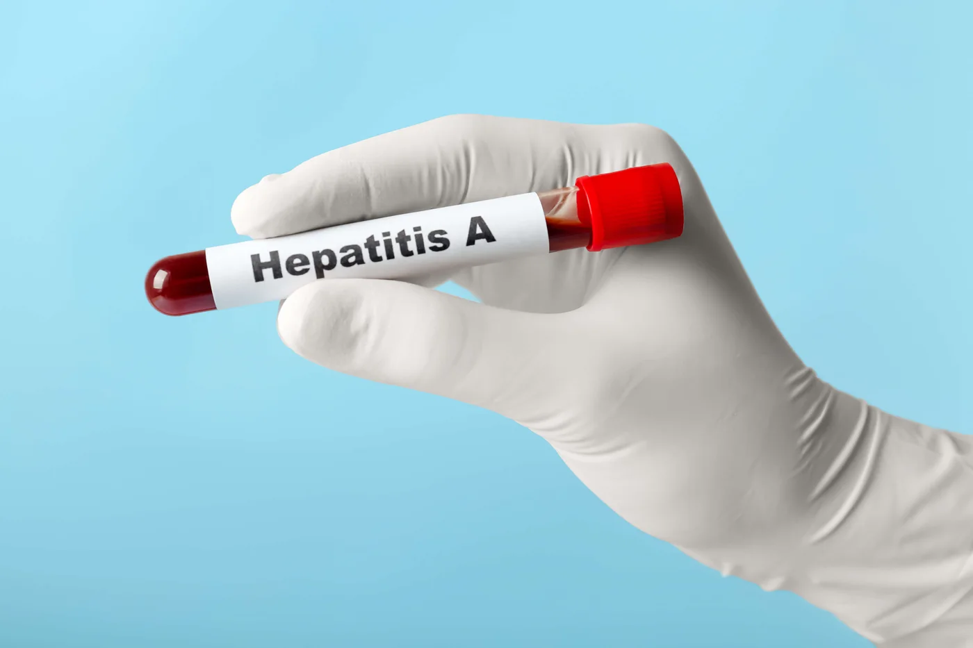 Hepatit ve Sarılık Nedir?