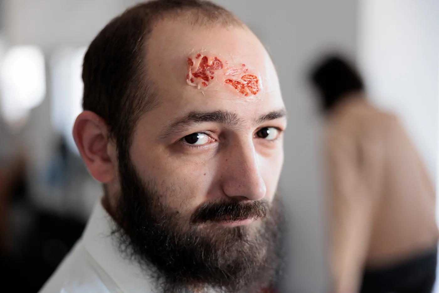Şark Çıbanı (Leishmaniasis) Nedir? Belirtileri ve Tedavisi